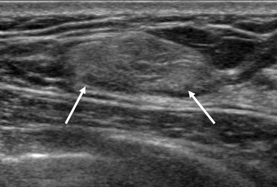 Axial T1-weighted spin echo MRI (TR/TE, 400/7) shows a 2 cm, oval shaped, circumscribed mass with central high signal intensity and peripheral iso signal