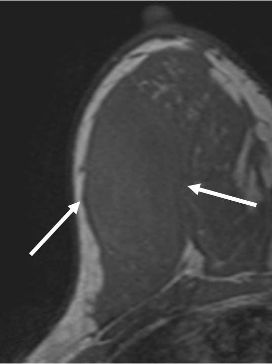 shaped, circumscribed, isodense mass at palpable site of the right breast (arrows).