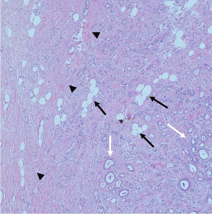 with mixed signal intensity (arrows). F.