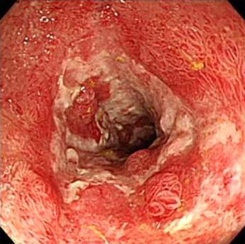 (B) One month after initial presentation, the necrotic and inflammatory mucosal changes had improved but stricture and benign circumferential healing stage ulcerations were noted.