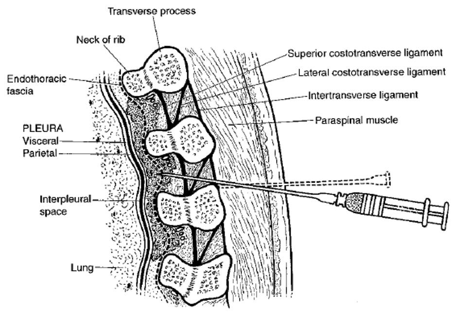 needle perpendicular to the skin until it contacts the lamina Redirect the needle approximately 15