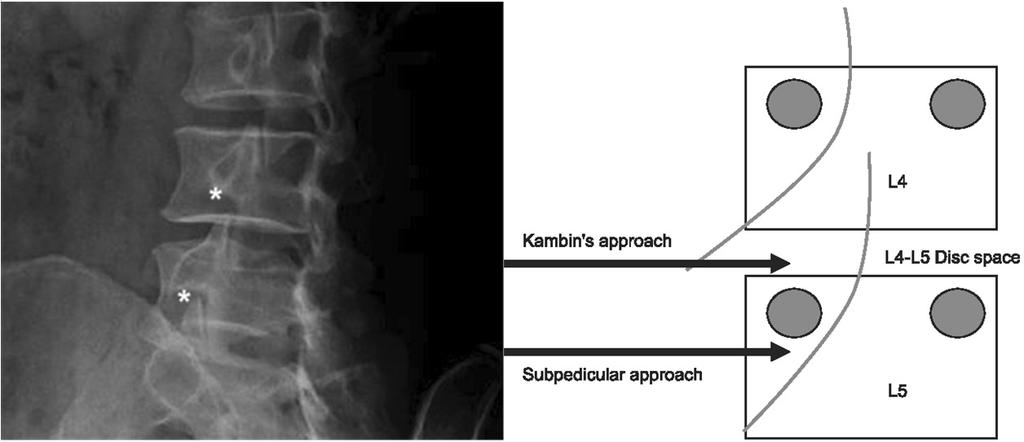 제 68 제차 68 대한통증학회차대한통증학회학술대회학술대회 Lumbar Spine (Interlaminar/Transforaminal Approach, MBB) 순천향의대마취통증의학교실 정호순 Lumbar Epidural Block Indication 1. 추간판퇴행과탈출증 2. 척수신경근의압박 3.