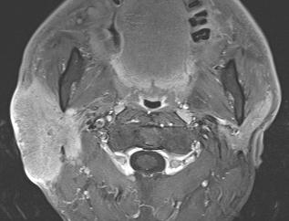 주변의연조직과피하지방조직및피부에침범할수있다 2, 3. C Fig. 1. 54-year-old male with trichilemmal carcinoma arising in the right parotid space.