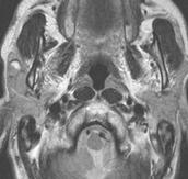 On CT image (), the mass demonstrates lobulated inhomogenous and mild enhancement.