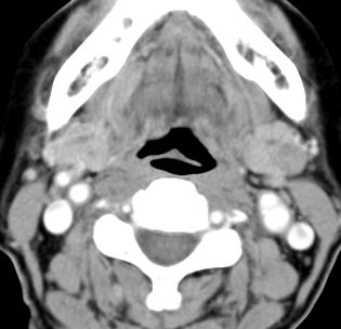 Post-contrast CT image shows less enhancing nodular solid mass in the left posterior submandibular gland