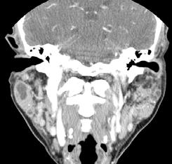 Left parotid gland presents fuzzy-margined inhomogenous and mild enhancing solid-cystic