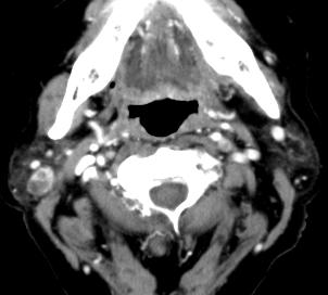 15-year-old female with pleomorphic adenoma in the left parotid gland. The mass shows central focal cystic change and mild peripheral enhancing solid component.