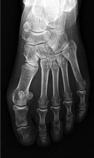 (A) Radiographs showing class 1 hallux abducto valgus, with no rotation observed on the axial view.