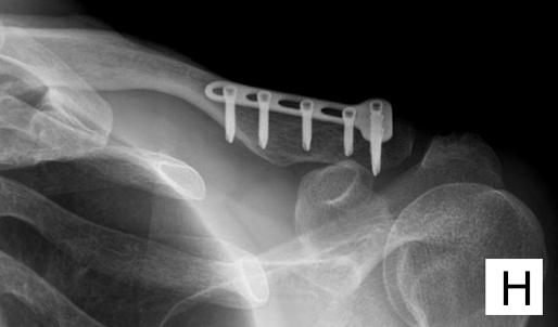 A 47yearold man sustained a clavicle lateral end fracture by a