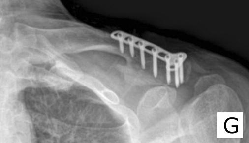 4 쇄골 외측 단 골절에 대한 사형 T형 잠김 압박 금속판을 이용한 수술적 치료 결과