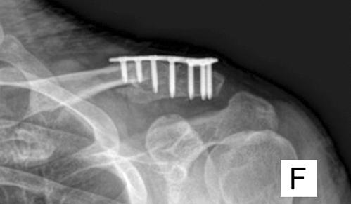 고 찰 Neer 제II형 원위 쇄골 골절은 오구쇄골 인대의 연결이 소실되어 주위