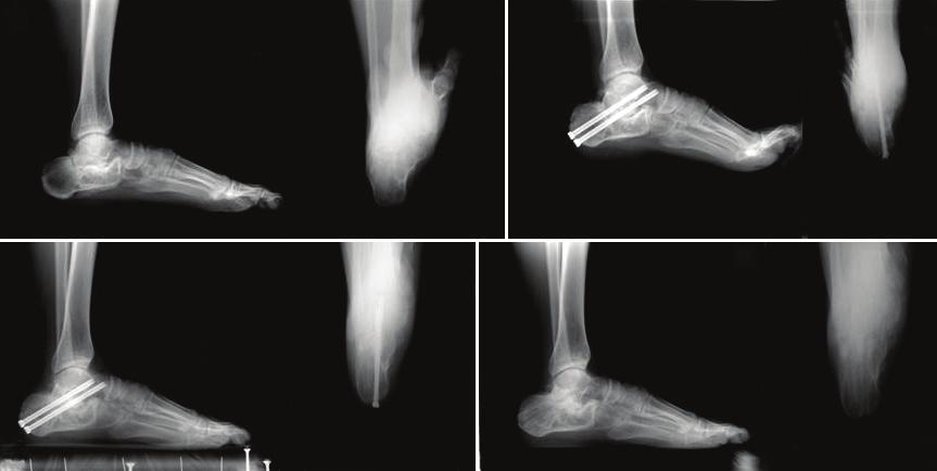 A B C D Figure 4. Right foot-ankle lateral view and axial view (A) initial, (B) immediate postoperation, (C) postoperative 3 months, (D) final follow-up (screw removal state).