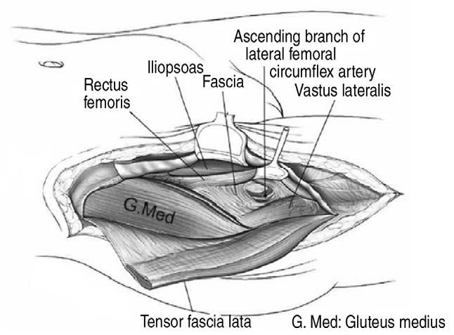3) 심층수술적절개 (deep surgical dissection) 심층절개단계에서는고관절외전근 ( 중둔근 ; 대퇴근막장근 ) 을장골의부착부에서박리하게된다 (Fig. 3). 전상장골극 (SIS) 에서시작하여대퇴근막장근을외측으로유리시켜장골의외측을수술의성격에맞게필요한만큼노출시킨다. 봉공근과대퇴근막장근사이의간격을벌리면중둔근과대퇴직근이보이게된다.