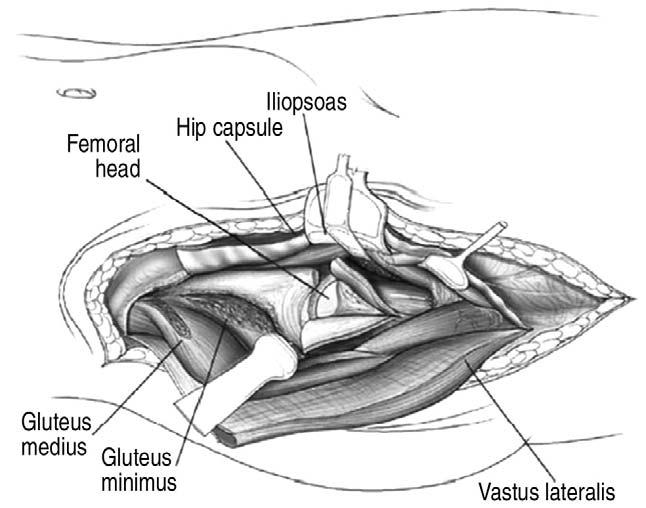 위부를위해대퇴외측근을절개한다. 비구의전방골주와골반내측벽으로접근하기위하여서혜인대 (inguinal ligament) 와봉공근을전상장골극에서절단할수있다 (Fig. 5).