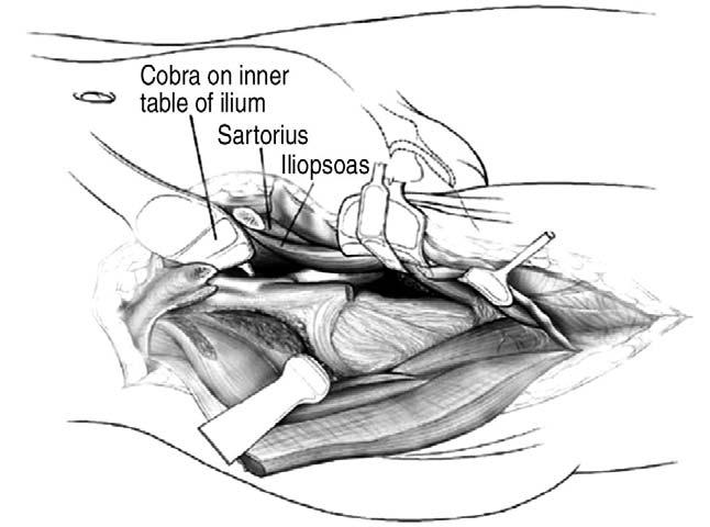 관절낭하방과장요건상부의사이에서외측대퇴회선동맥 (lateral femoral circumflex artery) 의분지를포함하고있는지방조직을잘분리하여야한다. 골반의내측을박리시키는경우장근혈종 (iliacus hematoma) 가생겨대퇴신경의지연마비가수술후발생될수도있어주의를요한다 3). 수술후봉합시외전근과대퇴장근막을두꺼운흡수성봉합사로봉합한다.