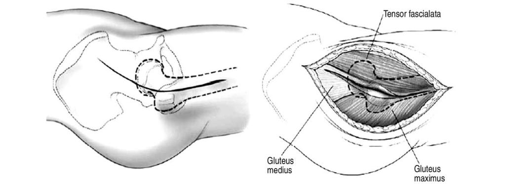 Tae-Young Kim et al.: nterior pproaches in Hip Surgery fascia lata) 사이의근육간공간 (intermuscular plane) 으로접근하므로신경간공간 (internervous plane) 접근이아니다.