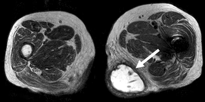 enhancement was showed on T1 weighted image (B). Fig. 3.