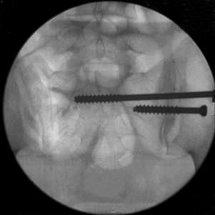 불안정성골반골절의치료시경피적천장골나사못의수와위치에대한비교 5 Fig. 3.