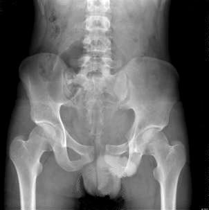 guidance. (E) Postoperative X-ray shows stable fixation with well reduction of the unstable pelvis.