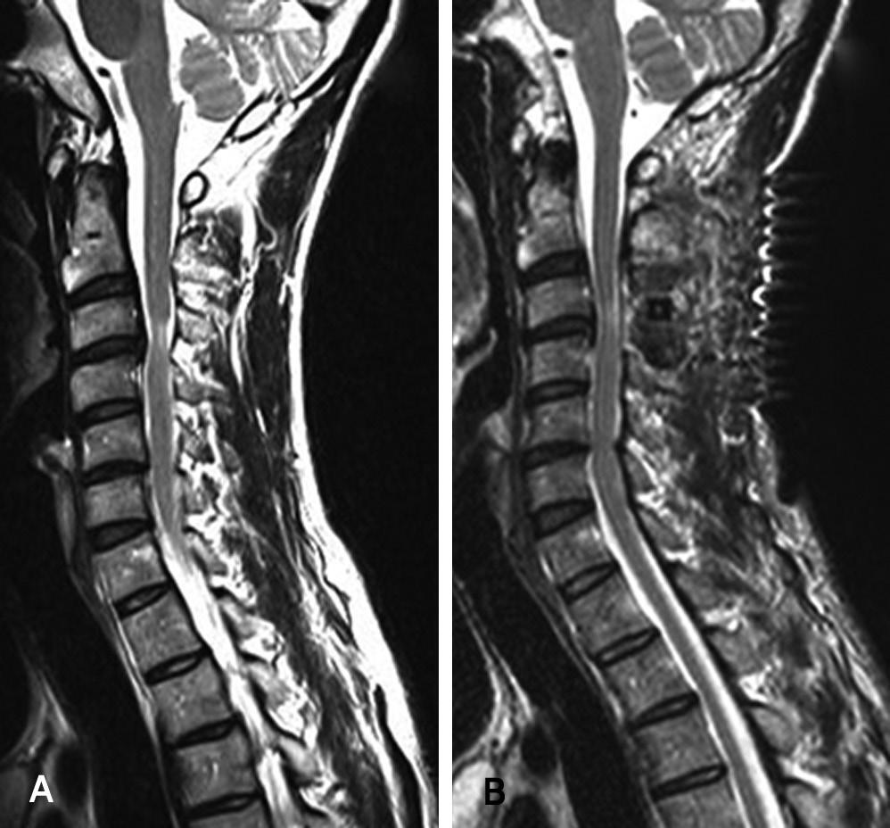 Journal of Korean Society of Spine Surgery Selective Laminoplasty for Cervical Myelopathy Fig. 5.