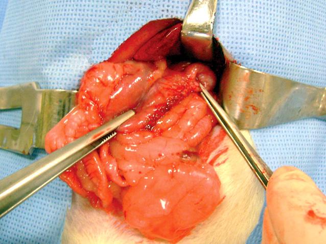이어서트라이츠인대 (ligament of Treitz) 하방 16 cm 원위부에서공장을분리하고 Roux limb을위파우치와 6-0 단일성흡수봉합사로약 Fig. 1. Completed Roux-en-Y gastric bypass.