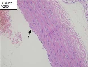 In (I), The arrow shows minor fat deposits in the