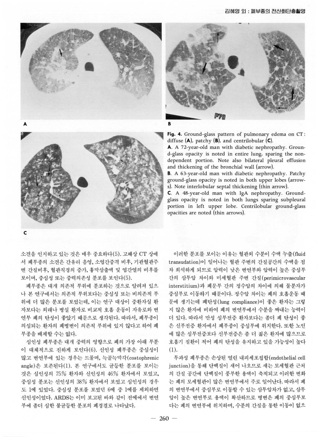 김혀 영오 1 : 며 부종의전신회단층활영 * A ", 댐횡 @ Fig. 4. Ground-glass pattern of pulmonary edema on CT: diffuse (A), patchy (B), and centrilobular (C). A. A 72-year-old man with diabetic nephropathy.