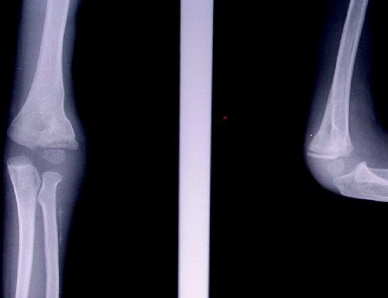 392 박희완, 김대야, 김현우 A B Fig. 2. (A) Initial fracture radiograph showed lateral condyle fracture.