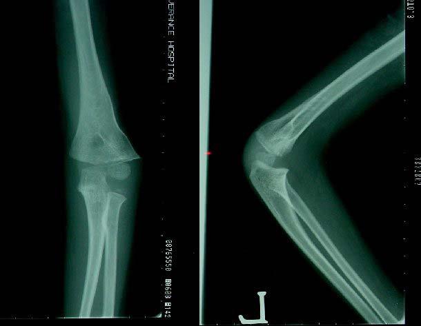 (A) Initial fracture radiograph showed greenstick fracture.