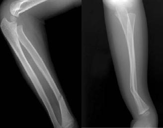 (C) Refracture radiograph showed complete both forearm fracture.