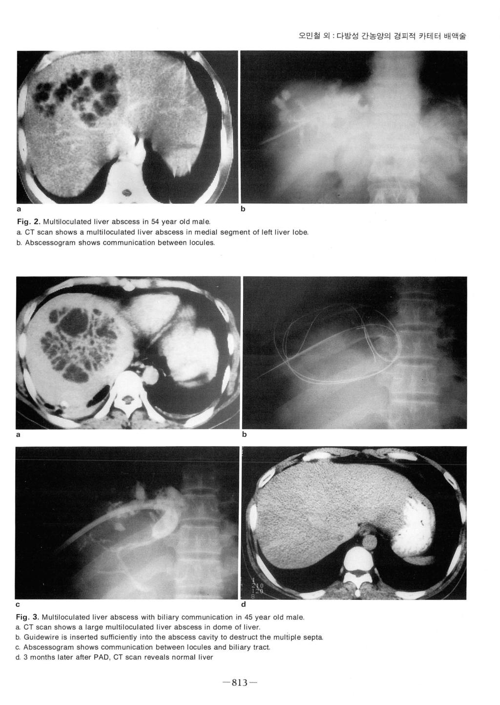 오민철오 다방성간농앙의경피적카테터배액술 a b Fig. 2. Multiloculated liver abscess in 54 year old male a. CT scan shows a multiloculated liver abscess in medial segment of left liver lobe b.