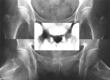 (A) AP and lateral radiographs obtained three months after pain show no definite abnormality. Bone scan in the inset shows increased radionuclide uptake in the right femoral head.