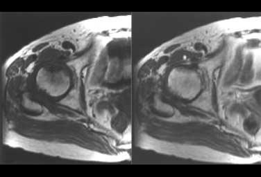 and fat suppressed -weighted images (bottom) obtained fourteen months after the onset of pain show the resolution of abnormal signal intensity changes. FS B A B Fig. 3. Patient 7, case 9.