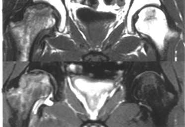 (B) -weighted and proton MR images show a diffuse area of signal intensity changes (asterisk) on the right femoral head and neck with fracture line