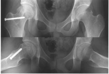 (C) Photographs during operation (left) show flattening of the femoral head and restoration of the contour by strut bone graft impaction (arrowhead)