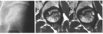 대퇴골두연골하스트레스골절 809 Fig. 5. A typical case of osteonecrosis of the femoral head (ONFH).