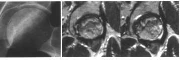 The bone marrow edema pattern (asterisk) is only shown outside the necrotic area. 후통증의소실을나타냈다. 대퇴골두의붕괴가심하였던 2예의경우에대해서는각각인공고관절전치환술과지주골이식술 (strut bone graft) 을시행하였다.