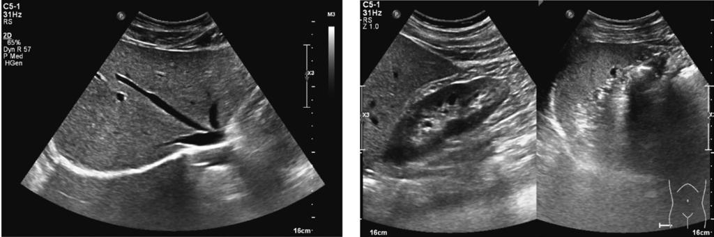 지방간정도와혈액학적검사및비만지표의상관관계 41 Fig. 1. Normal by Ultrasonography. Fig. 2. Grade I fatty liver by Ultrasonography.