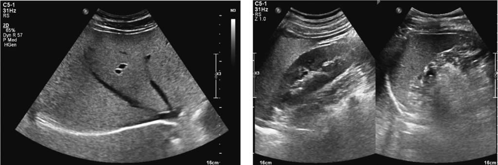 2), Grade II ( 중등도 ) 에는간실질에코정도 (liver echotexture) 가중등도밝게증가하고횡격막 (diaphragm) 과간내혈관 (liver intrahepatic vessels) 의경계가약간불분명하게보이는경우 (Fig.