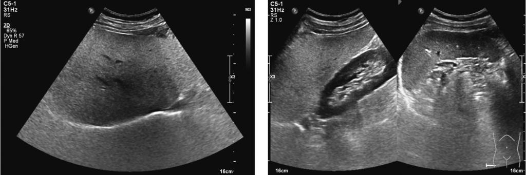 42 곽종길 문일봉 공창기 Fig. 3. Grade II fatty liver by Ultrasonography. morderate diffuse increase in echogenicity of the hepatic parenchyma with slightly impaired visualized diaphragm. Fig. 4.