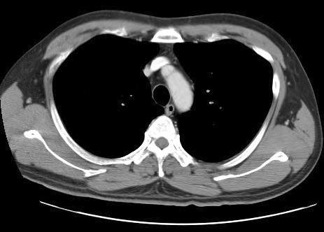 Chest and abdominal CT findings.
