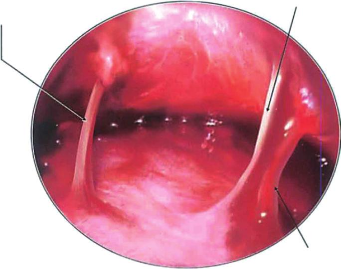 Innervation of the sensory nerves of the face. Sentinel vein (medial zygomaticotemporal vein) Fig. 2. Endoscopic view of the sentinel vein.