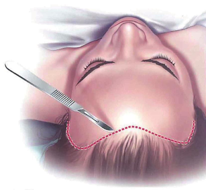 Elevation of the forehead flap via subgaleal and subperiosteal dissection after coronal incision.