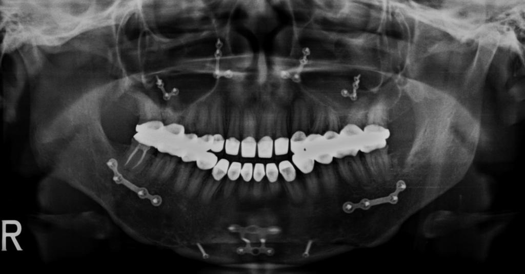 Ozturk, An interdisciplinary approach for restoring function and esthetics in a patient with amelogenesis imperfecta and malocclusion: a clinical report. J Prosthet Dent, 2004. 92(2): p. 112-5. 3.