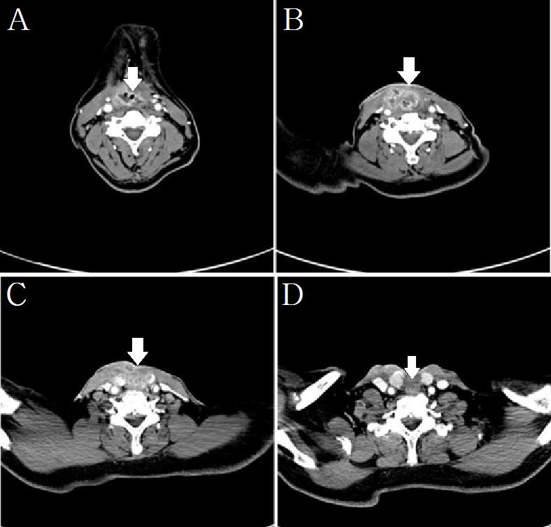 (A) This picture shows the appearance of stoma after 1 year of receiving total laryngectomy. (B) The posterior pharyngeal wall was edematous and ulcerative.