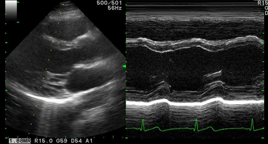 심장내경측정의일반적원리 (LV) Perpendicular to the interventricular septum and posterior wall 승모판전엽의끝부분에서측정
