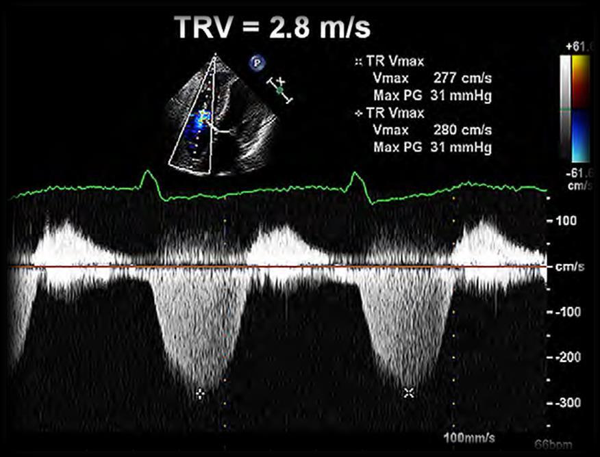 Pressure gradient from Doppler measurements Systolic pulmonary arterial pressure =