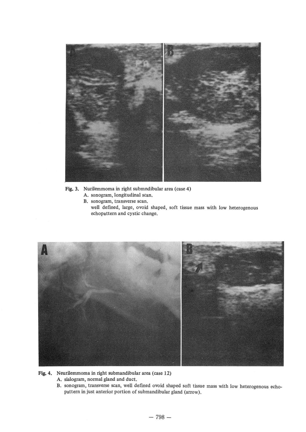 Fig.3. Nurilemmoma in right submndibular area (case 4) A. sonogram, longitudinal scan. B. sonogram, transverse scan.
