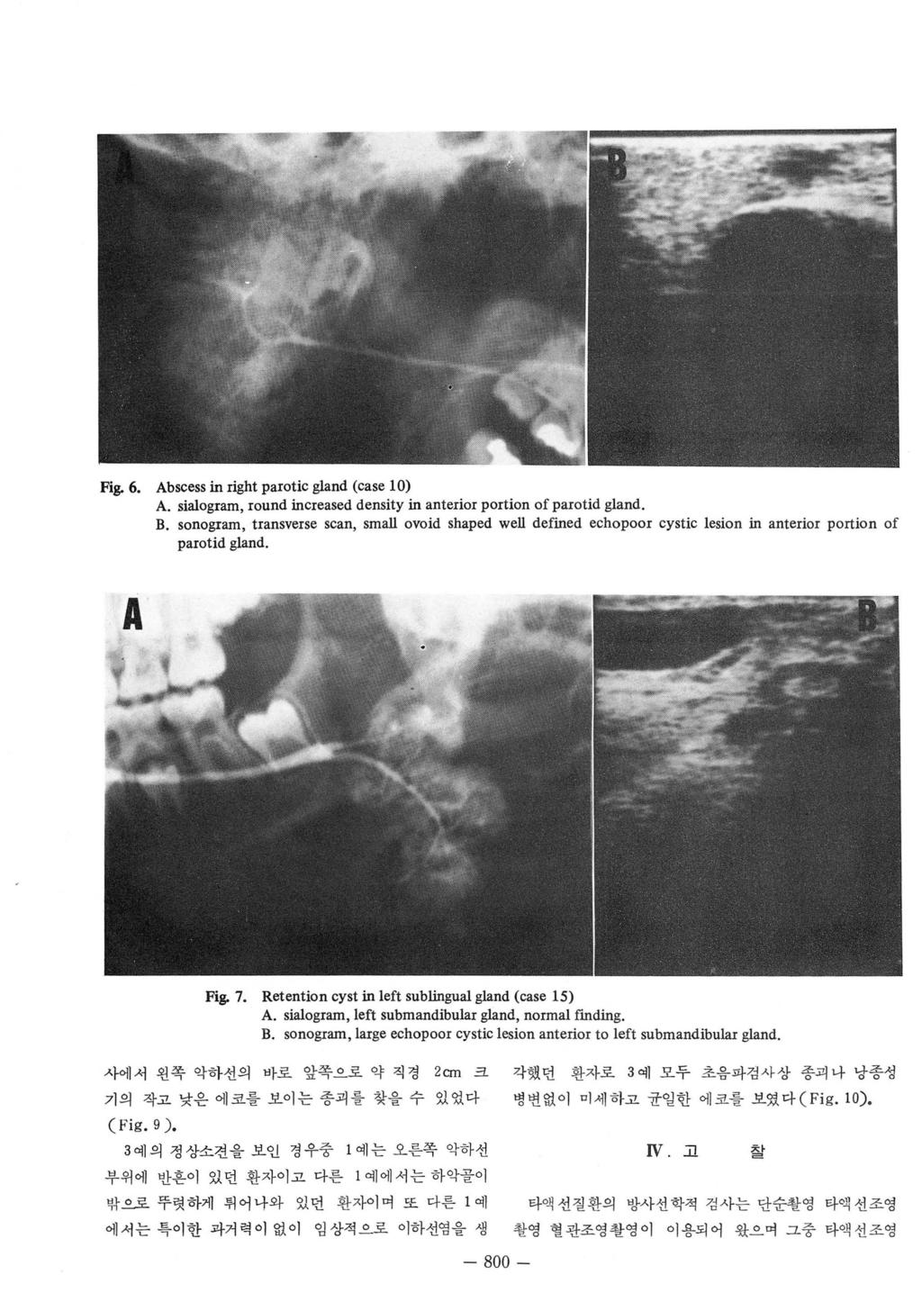 Fig. 6. Abscess in right parotic gland (case 0) A. siaogram, round increased density in anterior portion of parotid gland. B.