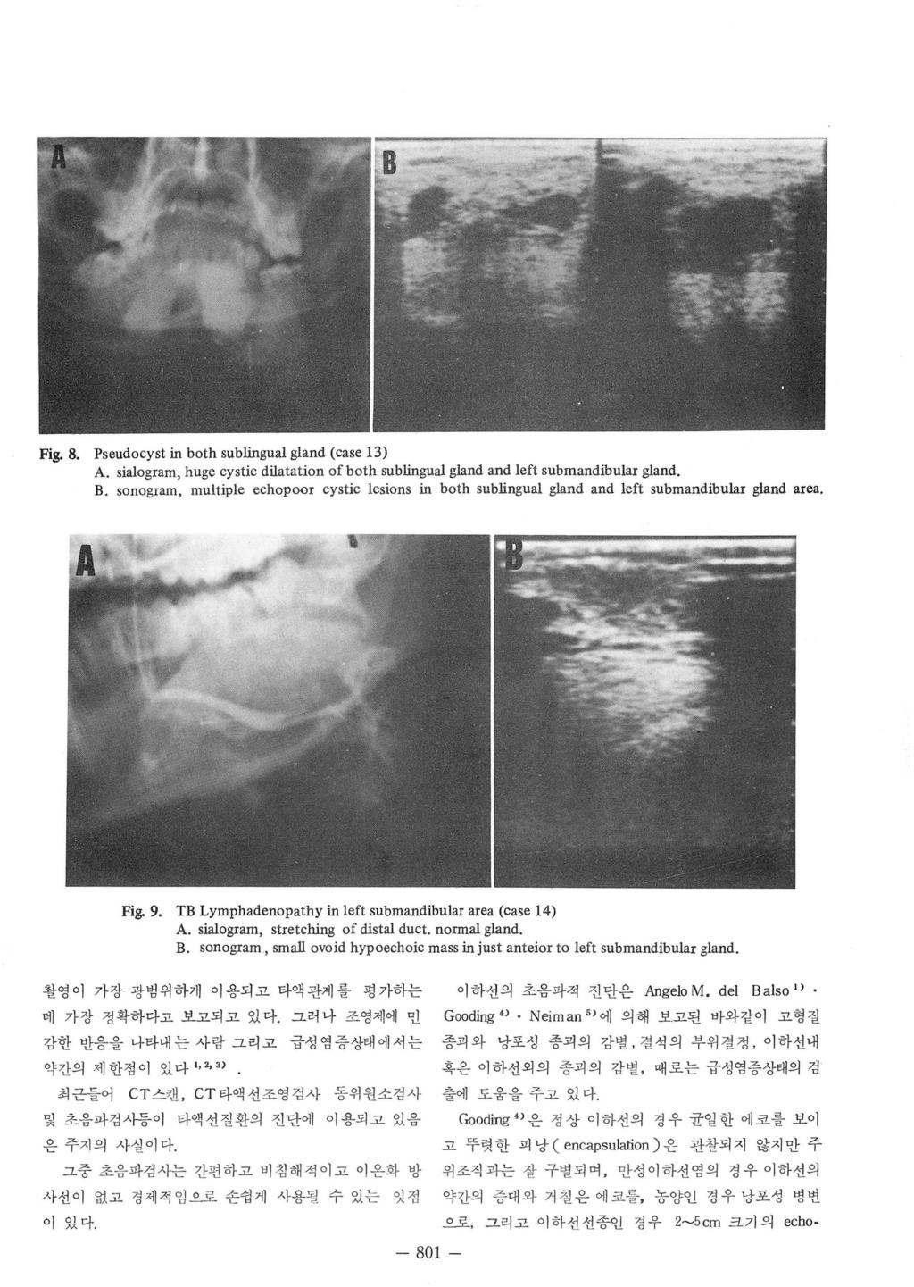 Fig. 8. Pseudocyst in both sublingual gland (case 3) A. sialogram, huge cystic dilatation ofboth sublingual gland and left submandibular 밍 and. B.